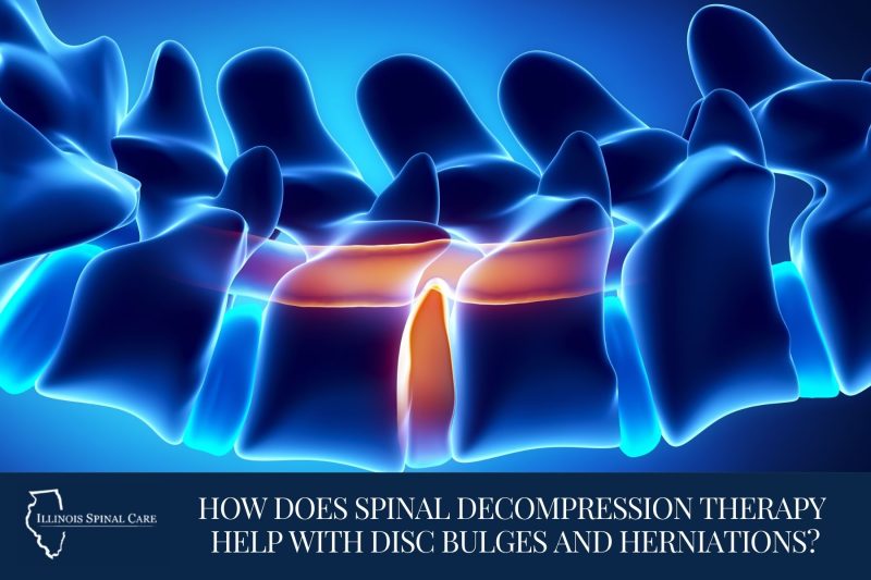 Learn how spinal decompression therapy relieves disc bulges and herniations, reduces nerve pressure, and restores mobility at Illinois Spinal Care in Elmhurst & Palatine, IL.